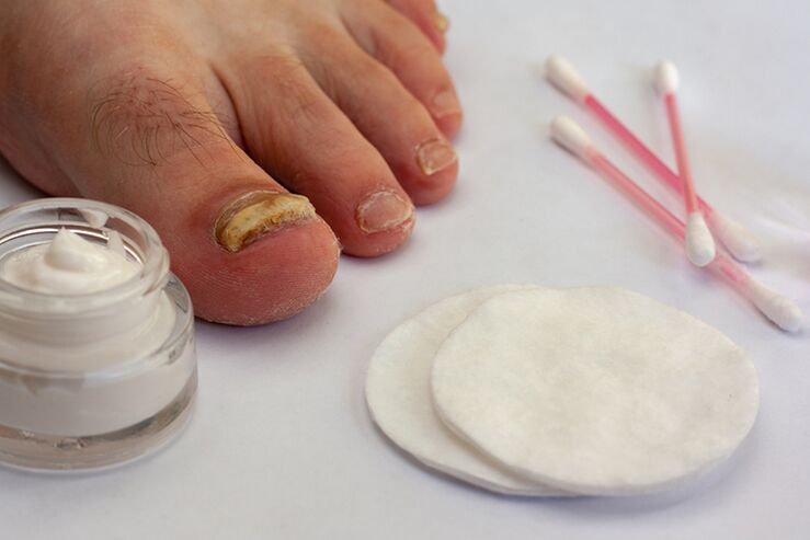 Toe fungus treatment with mushroom cream