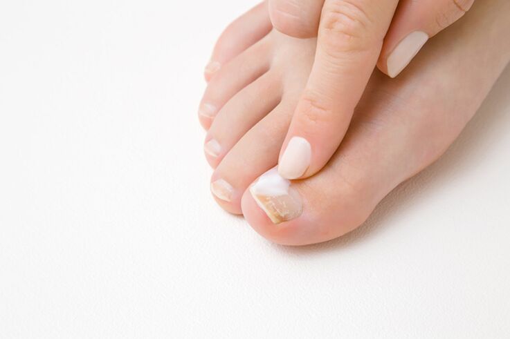 Treatment of toes with mushroom ointment
