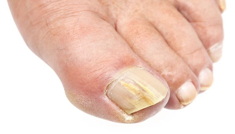 External changes in the nail are a sign of a fungal infection