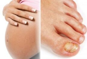 Pregnancy and toenail fungus