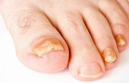 Yellowing of the toenails with fungus