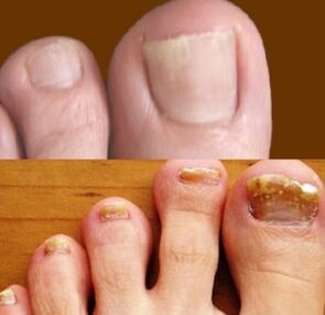 Initial and advanced stages of the fungus on the feet