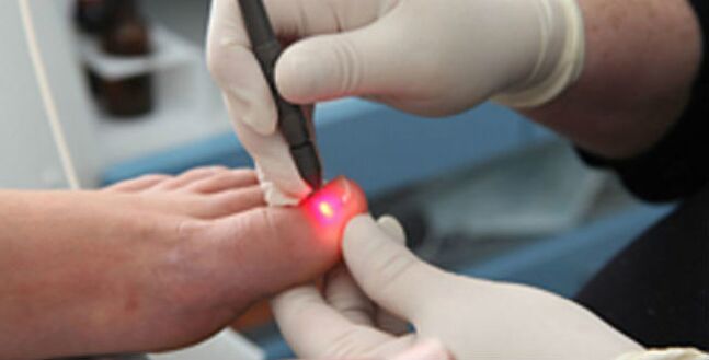 Laser therapy for nail fungus