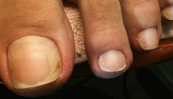 Signs of the early stages of toenail fungus