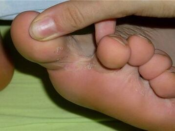 fungus between the toes