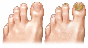 Healthy and infected fungal nails