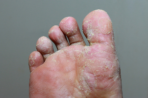The heavy Phase of fungal infection of the skin of the fingers on the legs