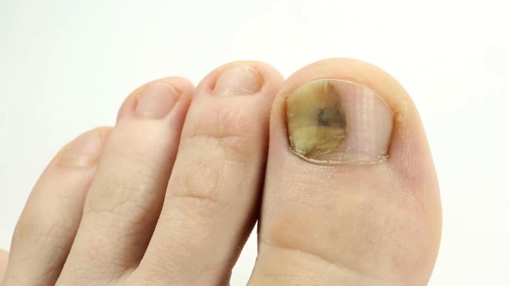 Appearance of a toenail affected by fungus